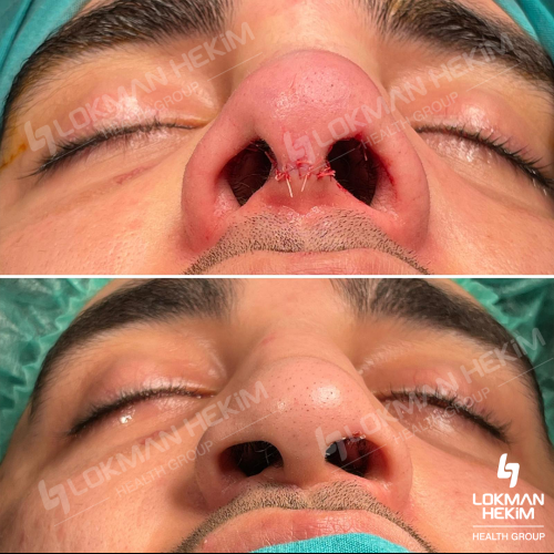 Rinoplastia (con injerto) Foto antes/después